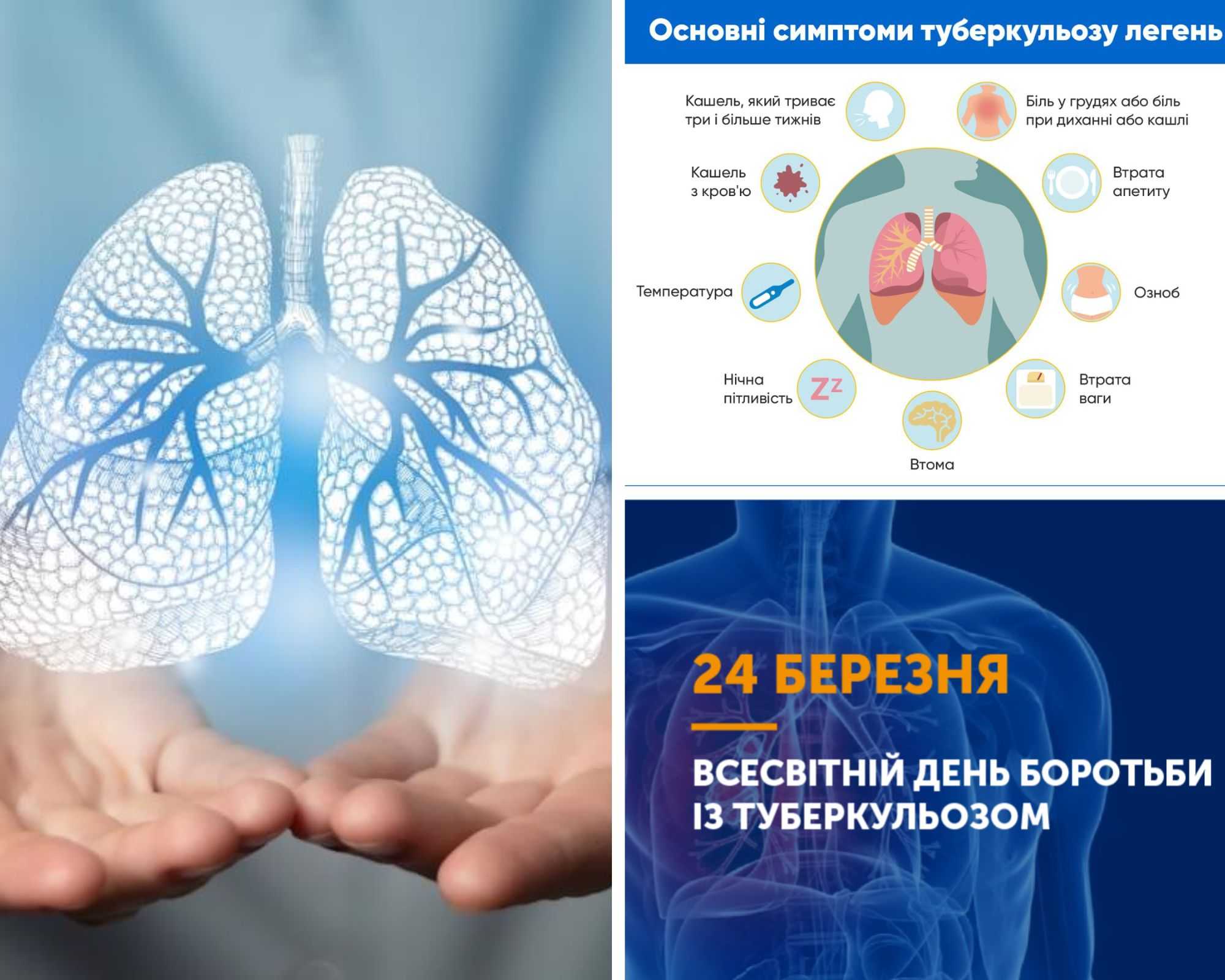 «ТАК! МИ МОЖЕМО ПОДОЛАТИ ТУБЕРКУЛЬОЗ. ЛІДЕРСТВО – ЗА ДЕРЖАВОЮ, СИЛА – В ГРОМАДАХ»