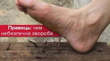 Правець: чим небезпечна хвороба